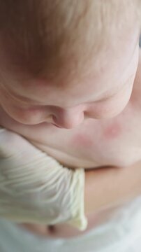 Close-up of a baby's chest showing red patches, possibly a rash, as a gloved hand gently holds the infant during examination A gloved hand gently supports the baby while the chest is