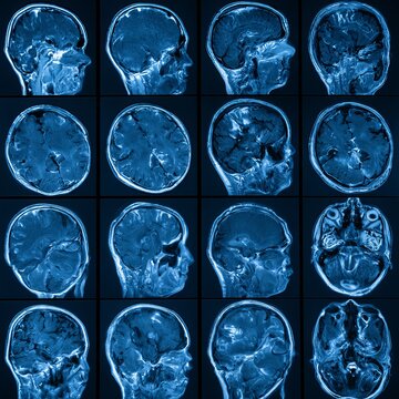 Medical scans of patient heads show health issues in blue shades against dark backgrounds.