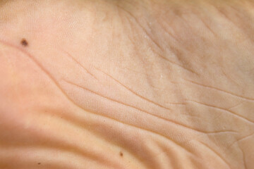 Fototapeta premium Mole or Black Nevus on the Skin of the Soles of the Feet