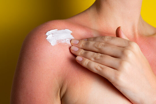 Close up of sunburned skin with severe redness and sunscreen cream applied to shoulder, UV damage concept