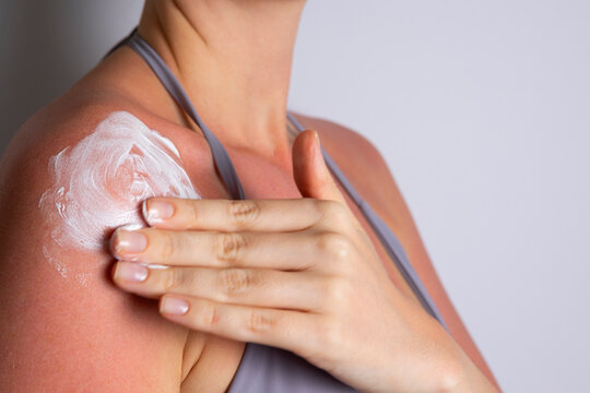 Close up of sunburned skin with severe redness and sunscreen cream applied to shoulder, UV damage concept