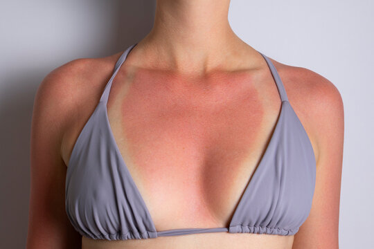 Close up of sunburned skin with severe redness and sunscreen cream applied to shoulder, UV damage concept