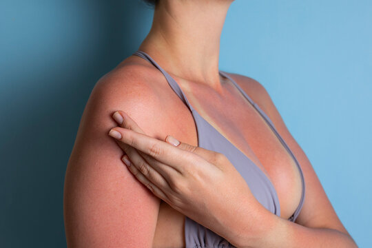 Close up of sunburned skin with severe redness and sunscreen cream applied to shoulder, UV damage concept
