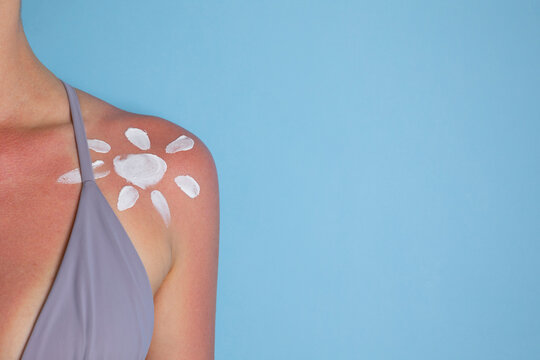Close up of sunburned skin with severe redness and sunscreen cream applied to shoulder, UV damage concept