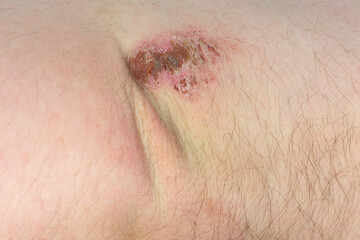 Fototapeta premium Close up of skin lesion or abrasion on human elbow, medical concept of wound healing or dermatology condition