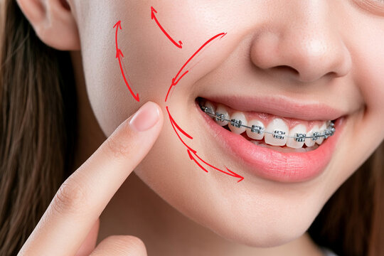 Girl shows her smile with braces and points to her cheek while arrows indicate movement