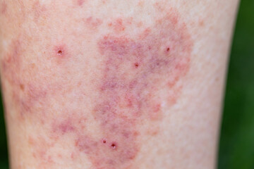 Fototapeta premium Extreme Close-Up of Bruised Skin with Red Spots and Small Scabs