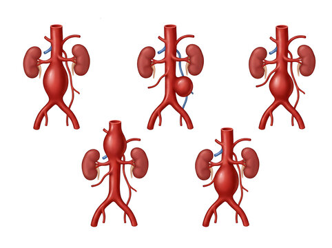 Abdominal Aortic Aneurysm Types with Kidneys and Major Blood Vessels, Human Vascular Anatomy, Arterial Disease, AAA Medical 3D Illustration and Educational Diagram