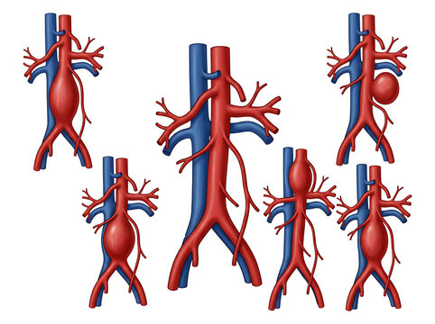 Abdominal Aortic Aneurysm Types with Major Arteries and Veins, Human Aorta Vascular Anatomy, Disease Variations, Cardiovascular Medical 3D Illustration