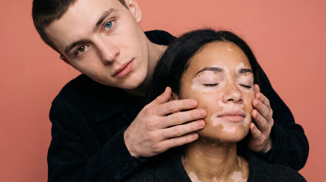 Man touching face of woman with vitiligo