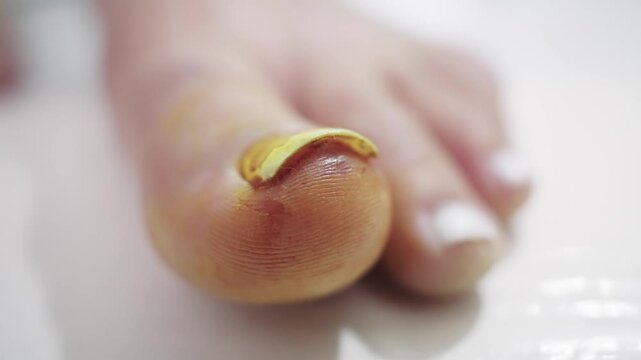 Foot With Paronychia Toe Nail Infection Close Up Detail