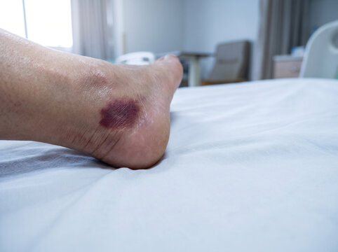 Early Stage Pressure Injury Non Blanching Redness on Adult Heel, Bedsore Prevention Nursing Care Medical Photograph