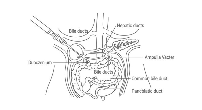 Medical Illustration: Biliary System and Duodenum Procedure