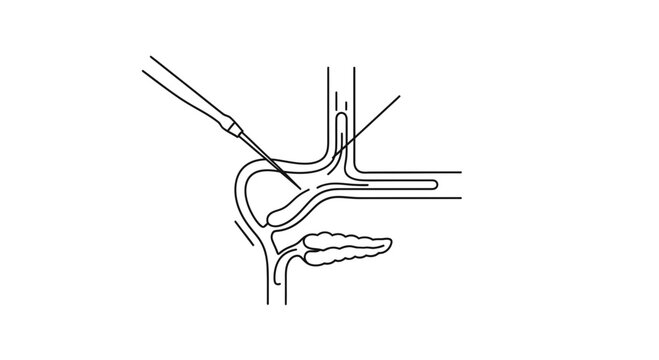 Medical Illustration of Fertilization Process in Fallopian Tube