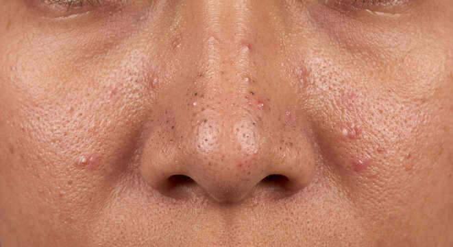 Mixed Acne Types / Clinical Acne Reference