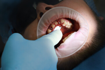 Dentist performing dental implant surgery, examining implant placement and surrounding tissue during oral surgery procedure in modern dental clinic © illustrissima