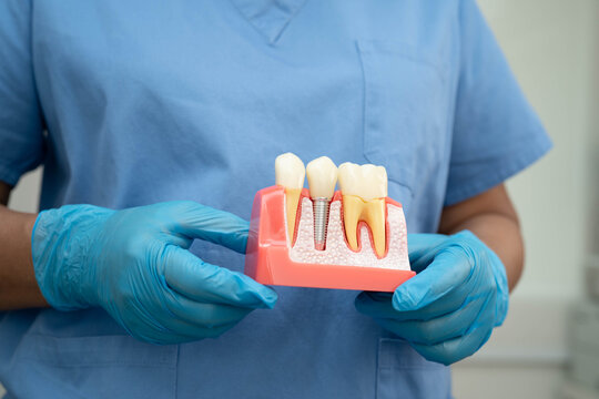 Dental implant, artificial tooth roots into jaw, root canal of dental treatment, gum disease, teeth model for dentist studying about dentistry.
