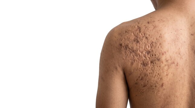Back view of man with severe acne scars and pockmarks on skin