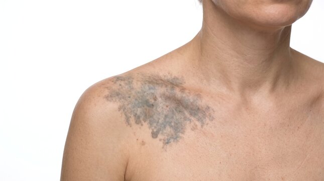 Nevus of Ota hyperpigmentation and birthmark on middle-aged female shoulder skin