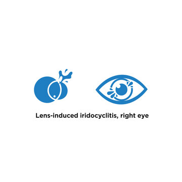 Lens-induced iridocyclitis affecting the right eye, medical illustration