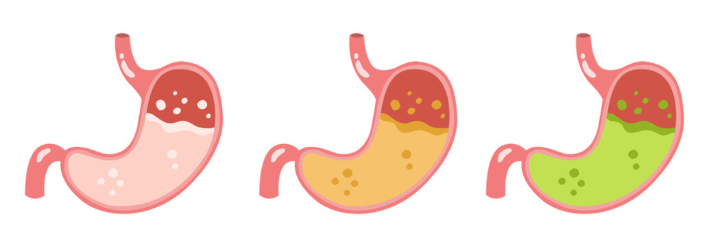 Set of three stomach illustrations showing different bile levels and digestive conditions