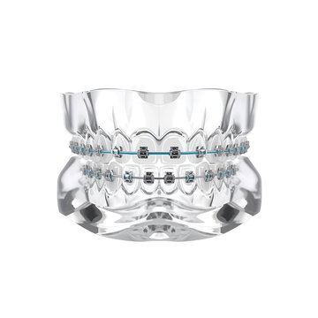 braces,-orthodontic,-dental,-teeth,-typodont,-metal-braces,-blue-ligatures,-smile-alignment,-dentistry,-dental-care,-oral-health,-medical,-equipment,-clinic,-treatment,-conceptual,white-background,jpg