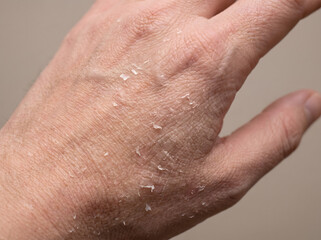 Fototapeta premium Dry flaky skin on a human hand showing severe dehydration and irritation requiring medical moisturizing cream for rapid healing relief