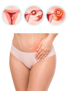 Female reproductive health and pelvic pain concept, uterus ovaries fallopian tubes and gynecological condition medical illustration