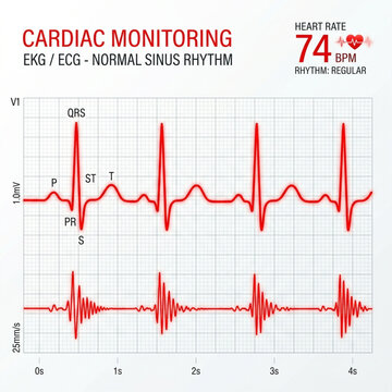 Medical EKG heart rhythm graph showing normal sinus rhythm