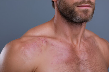 Naklejka premium Irritated underarm and shoulder skin with red bumps and shaving irritation on male chest, close up showing inflammation and texture