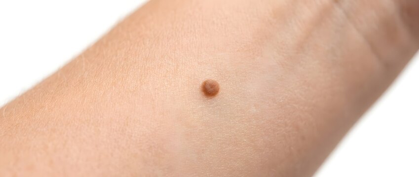 Close up of human skin with brown mole and copy space