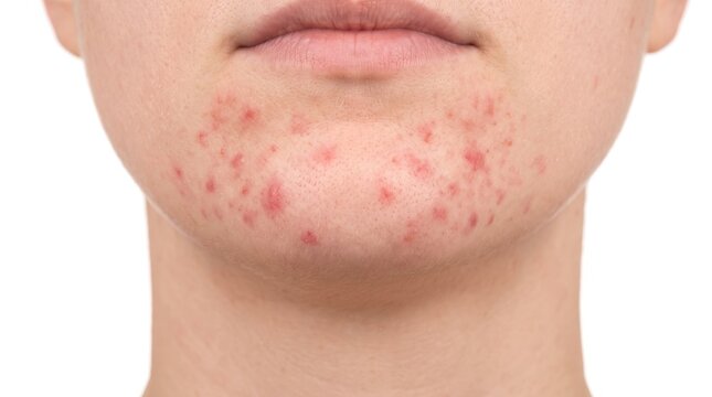 Frontal close up view of perioral dermatitis red papules and acne rash on chin skin