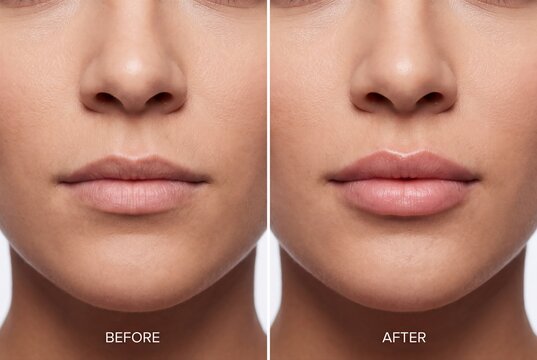 Lip filler before and after comparison cosmetic procedure treatment