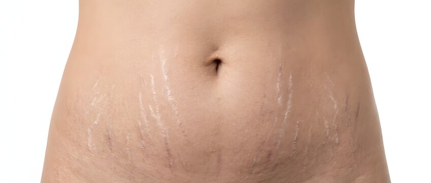 Close up of human skin with stretch marks and lotion