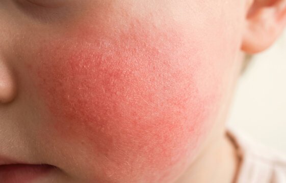 Close Up of Flushed Red Cheek Fifth Disease Slapped Cheek Syndrome on Child Face