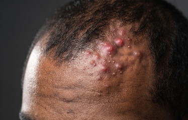 Naklejka premium Close Up of Severe Cystic Acne Folliculitis Bumps on African American Man Scalp