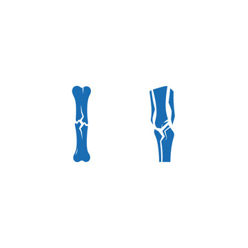 Medical illustration of human leg bones with fracture and surgical repair