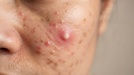 Fototapeta premium Close up view of skin with inflammatory acne and pustules showing redness and clogged pores on cheek area during dermatology examination for medical skincare treatment.
