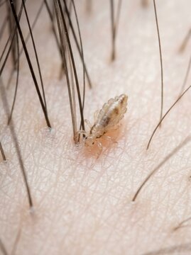 Close up macro of a head louse on a human scalp at the base of dark hair follicles. Parasitic insect infestation on skin. Pediculosis medical concept