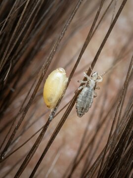 Macro photograph of an adult head louse and a yellow nit egg attached to dark hair strands near the scalp. Parasite life cycle