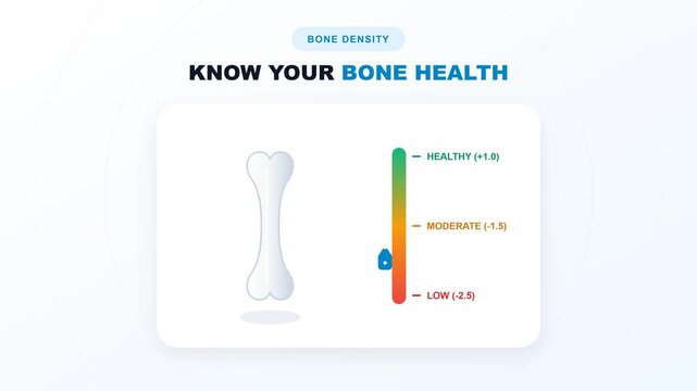 Flat design 2D animation of bone density levels for World Osteoporosis Day health awareness.