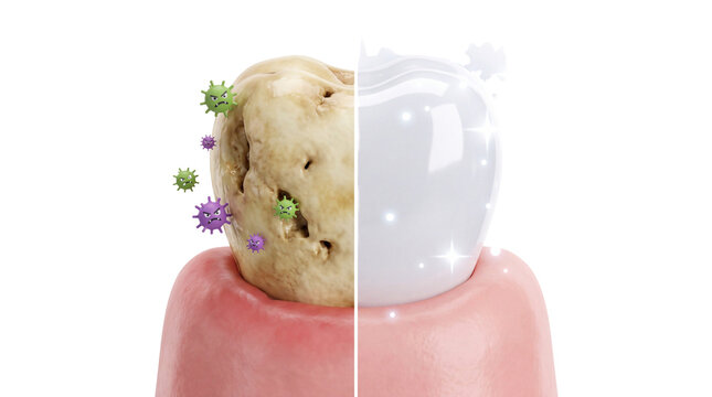 Dental whitening comparison, damaged yellow tooth with bacteria versus clean white tooth, oral hygiene and dentistry care