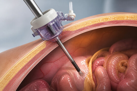 Laparoscopic Port Entry Into Abdominal Cavity Illustration
