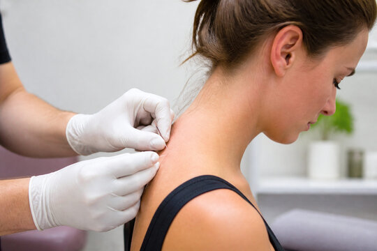 Dry needling therapy on neck and shoulder