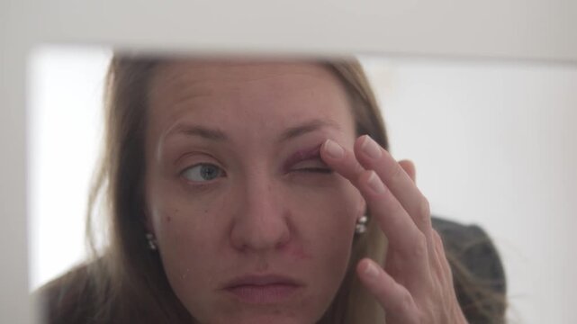 Young woman examining a bruise under her eye in the mirror, touching injured skin and checking facial trauma. Concept of injury, accident, domestic violence awareness, health concern and recovery