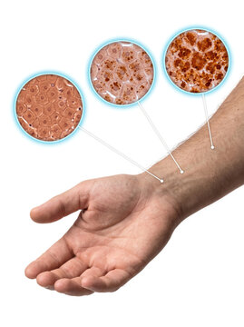 Skin lesion progression and melanoma concept, human forearm showing changing pigmented skin cells and dermatology cancer awareness illustration
