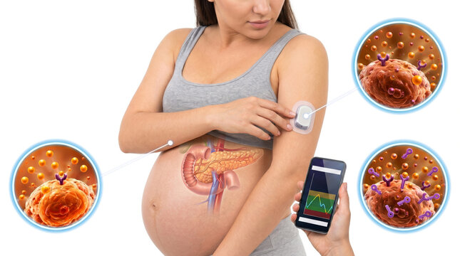 Gestational diabetes during pregnancy concept, pregnant woman monitoring blood sugar with glucose meter and insulin injection medical illustration