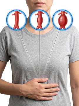 Abdominal aortic aneurysm progression and artery dilation concept, abdominal pain vascular disease and blood vessel anatomy medical illustration