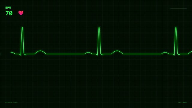 Green ECG Heart Rate Monitor Displaying Normal Sinus Rhythm in Hospital.