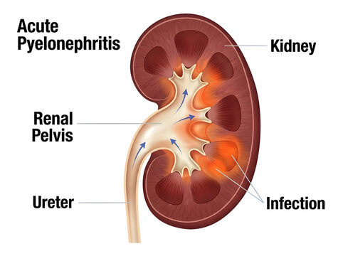 Acute pyelonephritis infection in kidney diagram isolated on white background